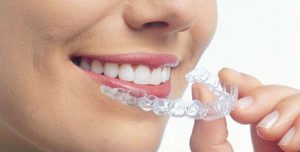 مراحل تركيب تقويم الاسنان