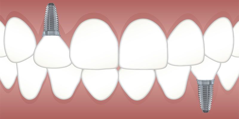 عملية-زراعة-الأسنان