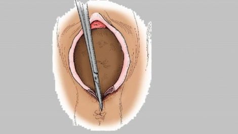 الخياطة التجميلية بعد الولادة بالصور