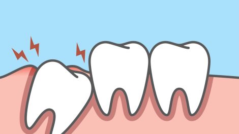 هل عملية خلع ضرس العقل مؤلمة