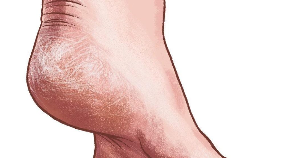 علاج تشققات القدم