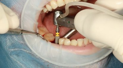 هل زراعة الاسنان مؤلمة
